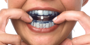 Advantages of Using Oral Appliance Therapy (OAT) to Treat Obstructive Sleep Apnea