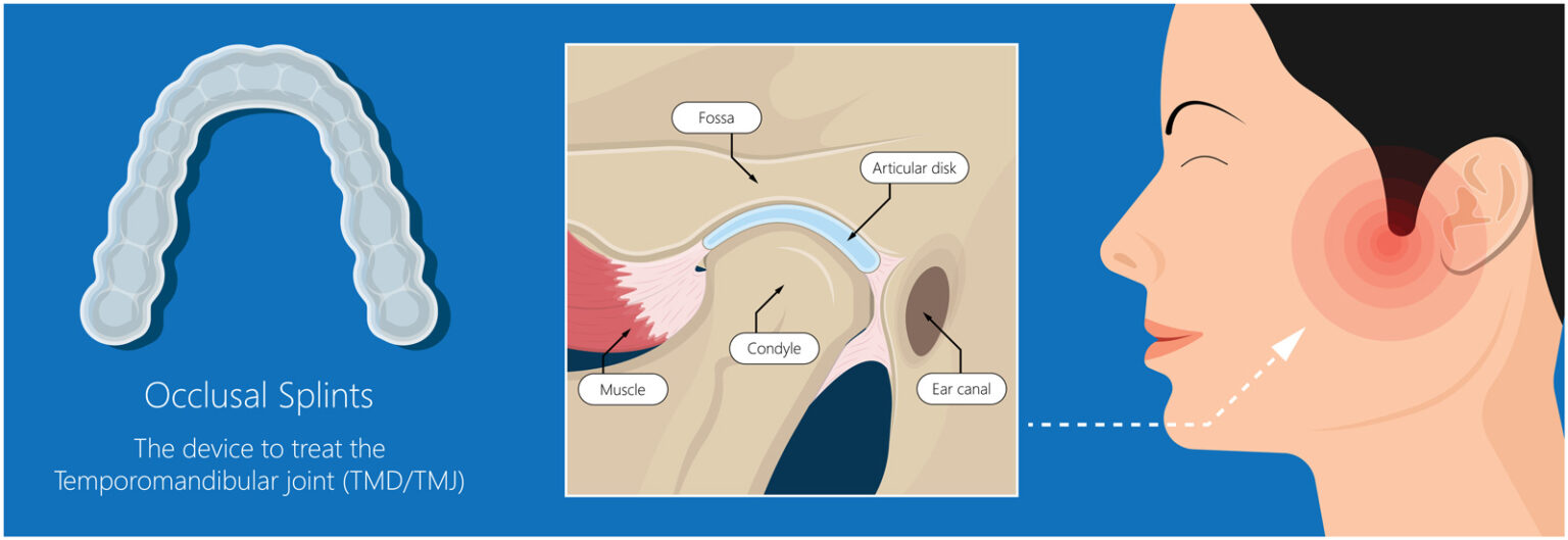 Advantages of using splint therapy for TMJ pain - TMJ Sleep Apnea